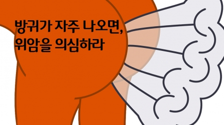 방귀가 자주 나오면, 위암을 의심하라